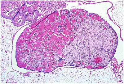 Ovarian Angiectasis