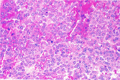 Pheochromocytoma