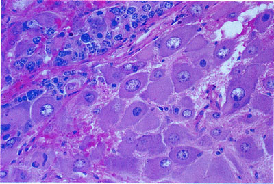 Ganglioneuroma - Adrenal
